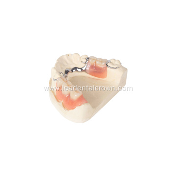 Custom-Fitted Metal Partial Dentures